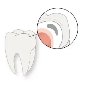 Demineralization Occurs